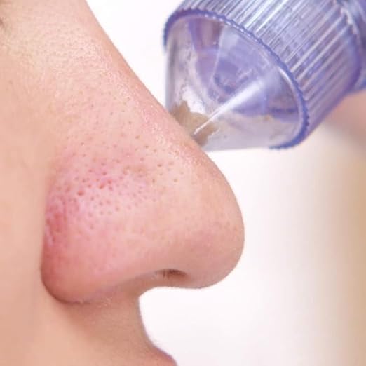 Derma Suction Electric Facial Pore Cleanser – Vacuum Blackhead Remover & Acne Suction Tool with 4 Interchangeable Heads